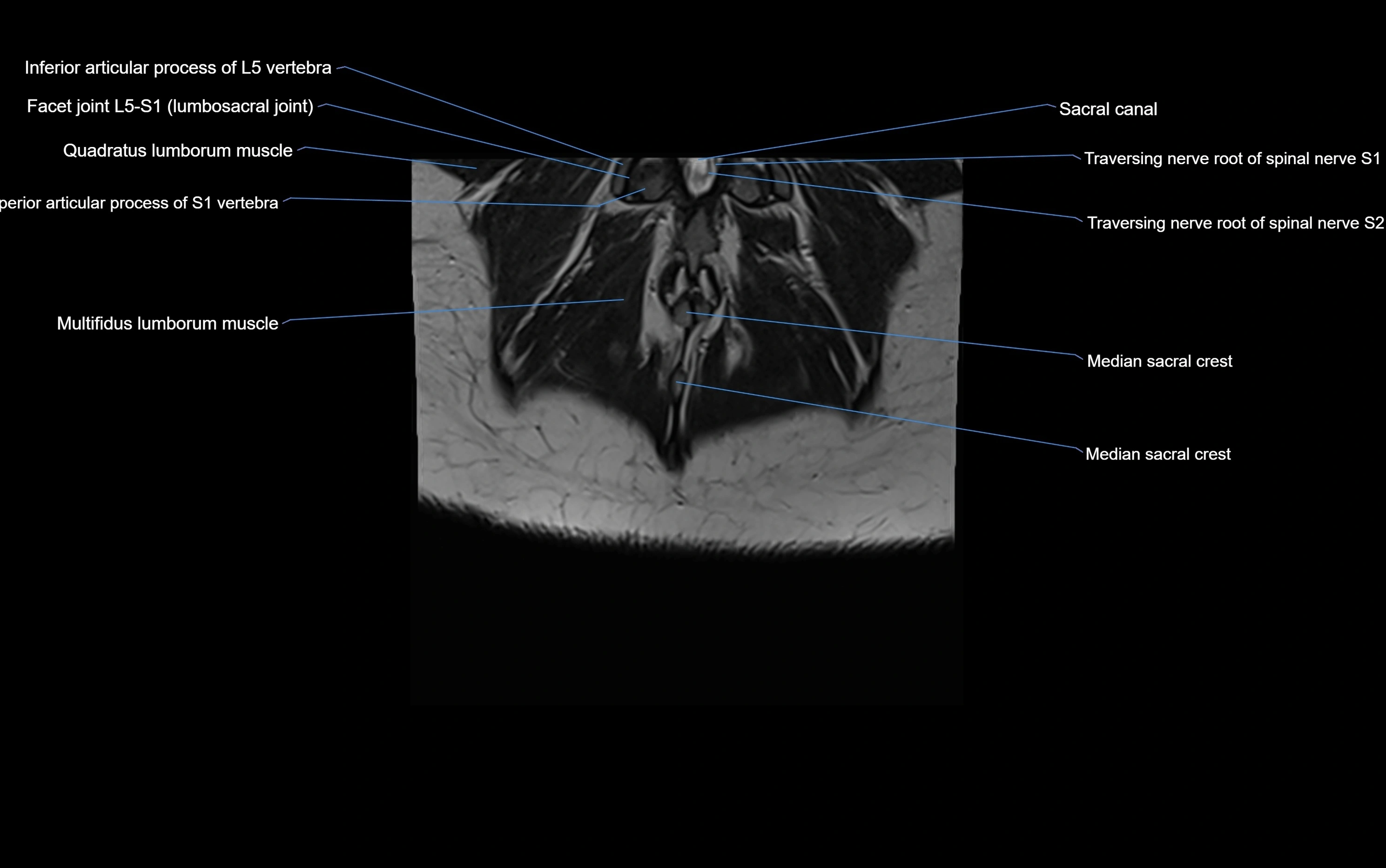 MRI sacroiliac joint coronal cross sectional anatomy  radiology  image-img-00001-00030.webp